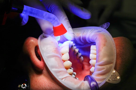 Mouth open and dentist using UV light 